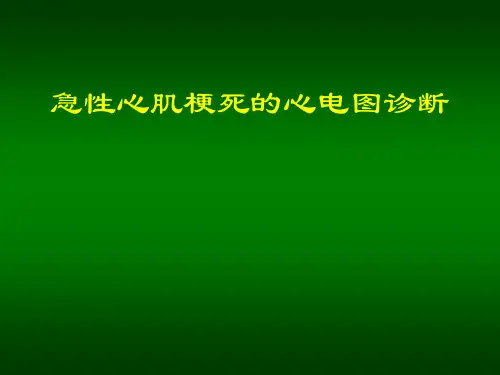 急性心肌梗死心电图解析