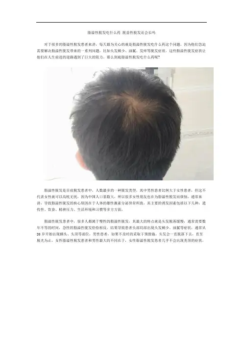 脂溢性脱发吃什么药 脱益性脱发还会长吗