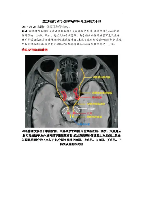 这些病因导致的动眼神经麻痹,处理原则大不同