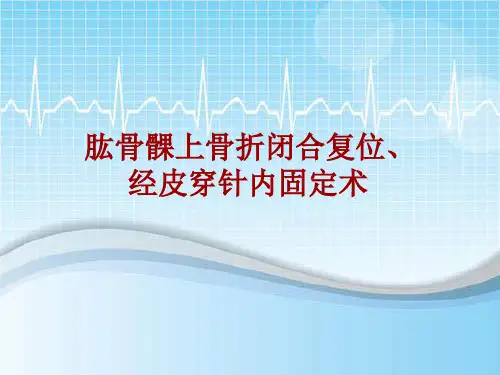 手术讲解模板：肱骨髁上骨折闭合复位、经皮穿针内固定术