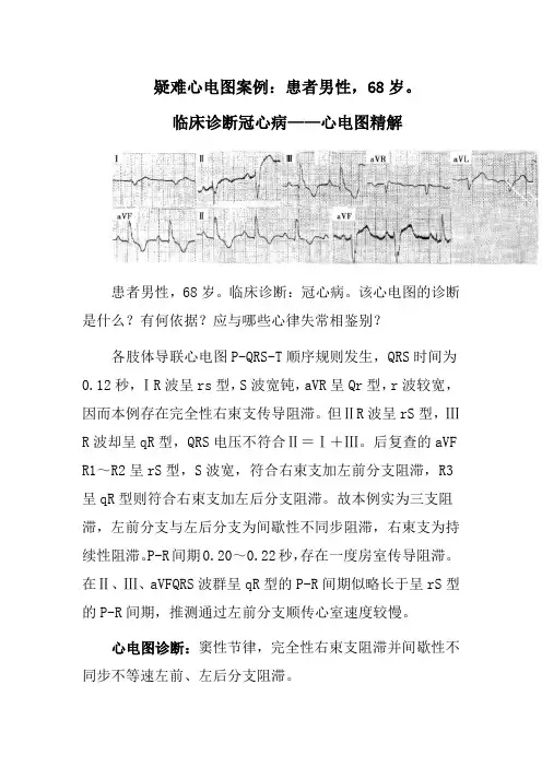 疑难心电图案例：患者男性,68岁。临床诊断冠心病——心电图精解