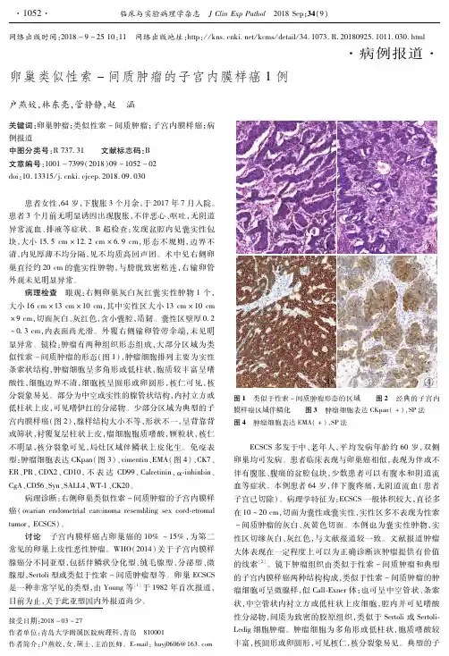 卵巢类似性索-间质肿瘤的子宫内膜样癌1例