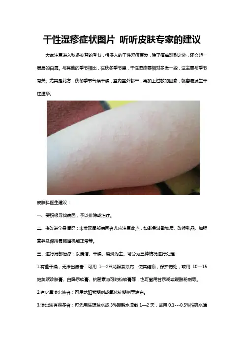 干性湿疹症状图片 听听皮肤专家的建议