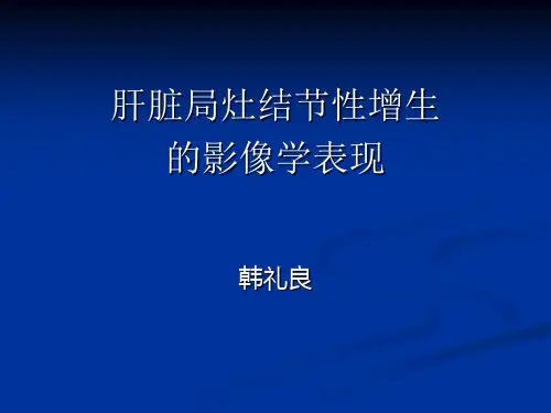 肝脏局灶性结节增生的影像学表现