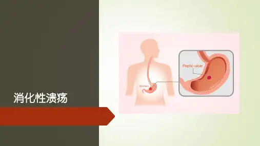 消化性溃疡