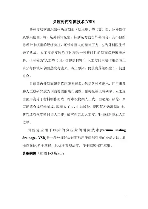 骨科--负压封闭引流技术(VSD)