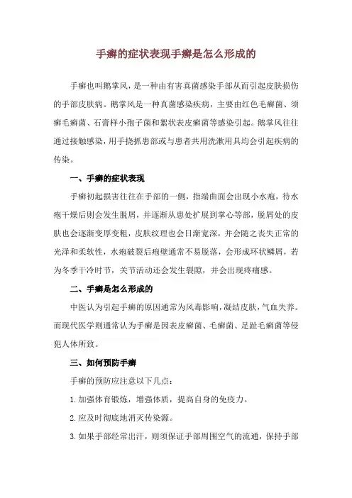 手癣的症状表现 手癣是怎么形成的