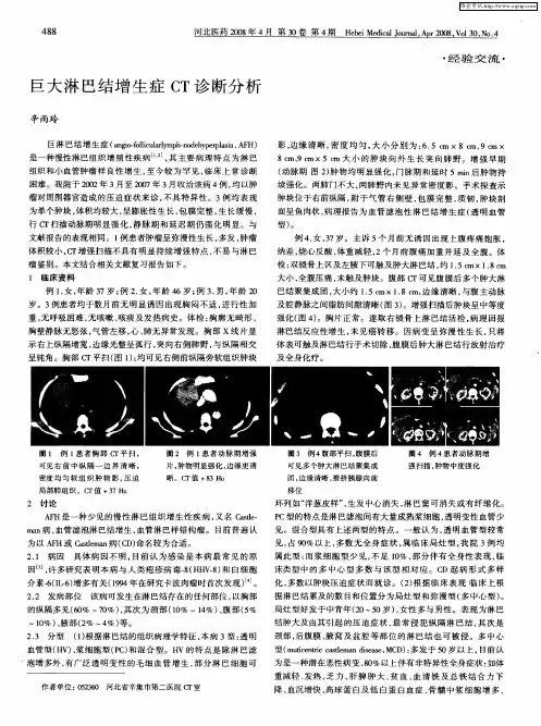 巨大淋巴结增生症CT诊断分析