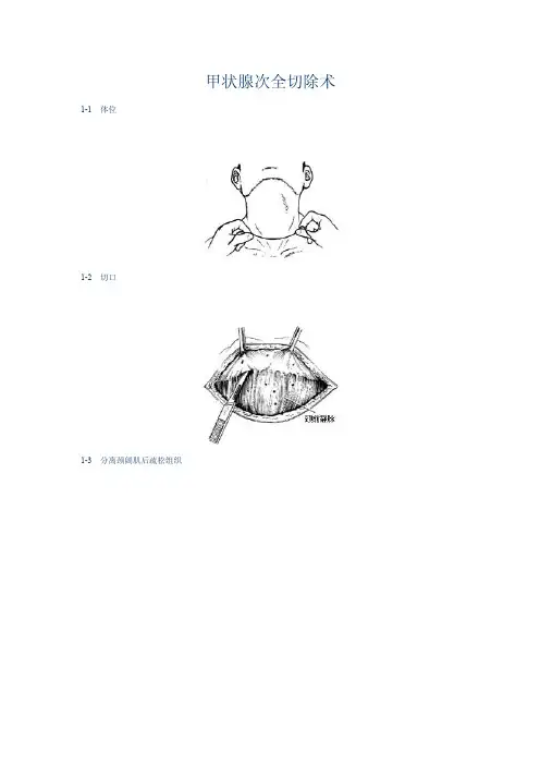 甲状腺次全切除术手术图谱