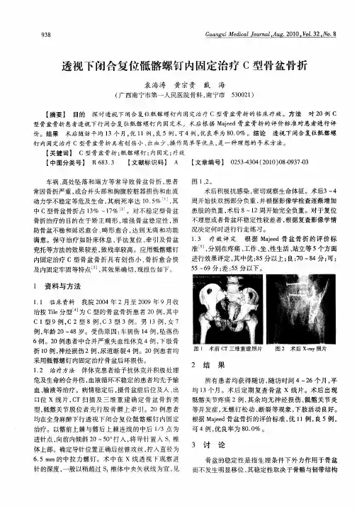 透视下闭合复位骶髂螺钉内固定治疗C型骨盆骨折