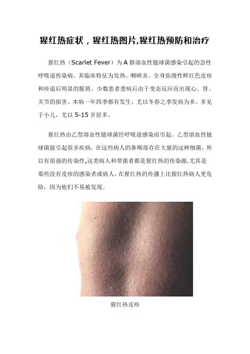 猩红热症状治疗预防及图片