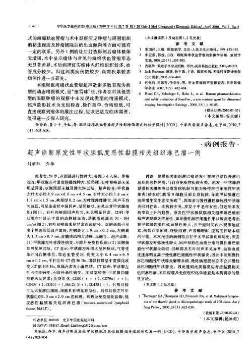 超声诊断原发性甲状腺低度恶性黏膜相关组织淋巴瘤一例
