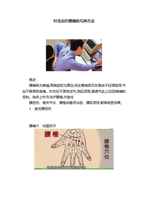 针灸治疗腰痛的几种方法
