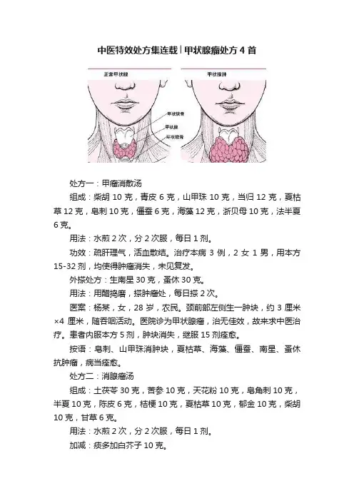 中医特效处方集连载│甲状腺瘤处方4首