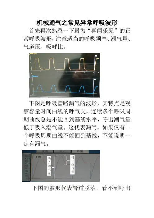 机械通气之常见异常呼吸波形
