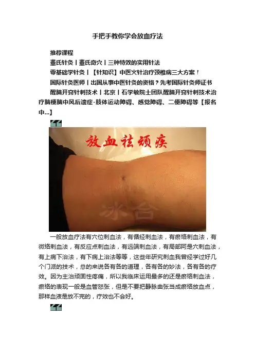 手把手教你学会放血疗法