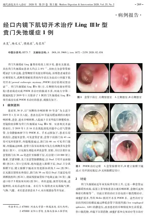经口内镜下肌切开术治疗ling Ⅲlr型贲门失弛缓症1例