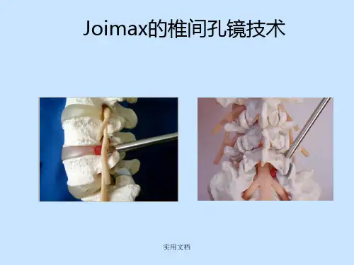 椎间孔镜手术操作方法