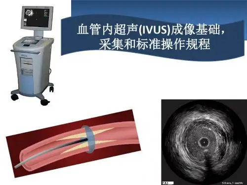 血管内超声IVUS简介