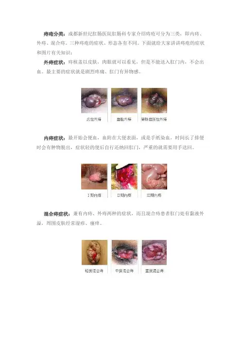看图了解痔疮