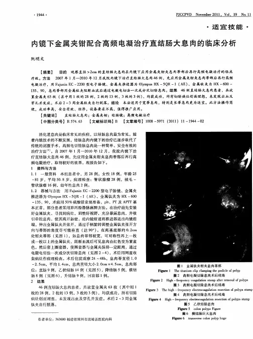 内镜下金属夹钳配合高频电凝治疗直结肠大息肉的临床分析