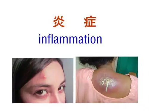 【病理】4.炎症概述