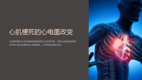 心肌梗死的心电图改变
