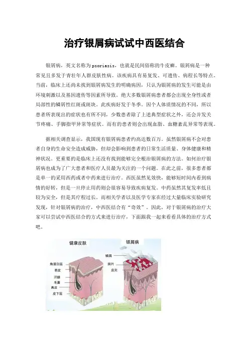 治疗银屑病试试中西医结合