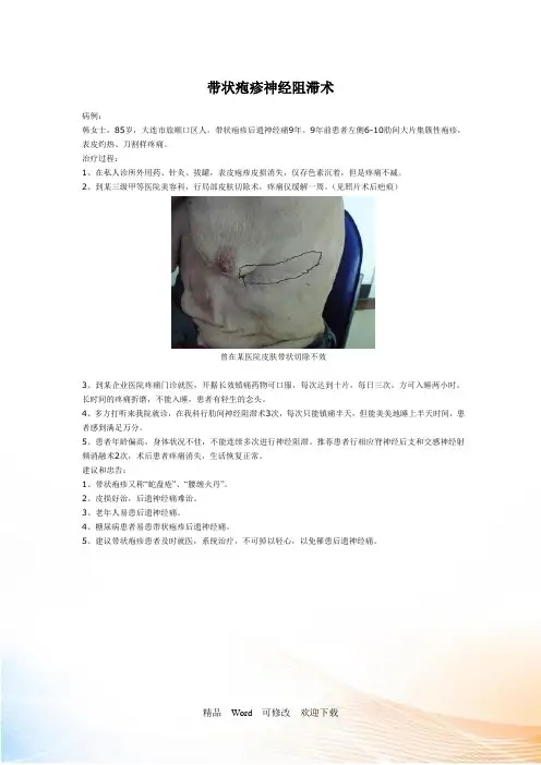 最新 带状疱疹后遗神经痛