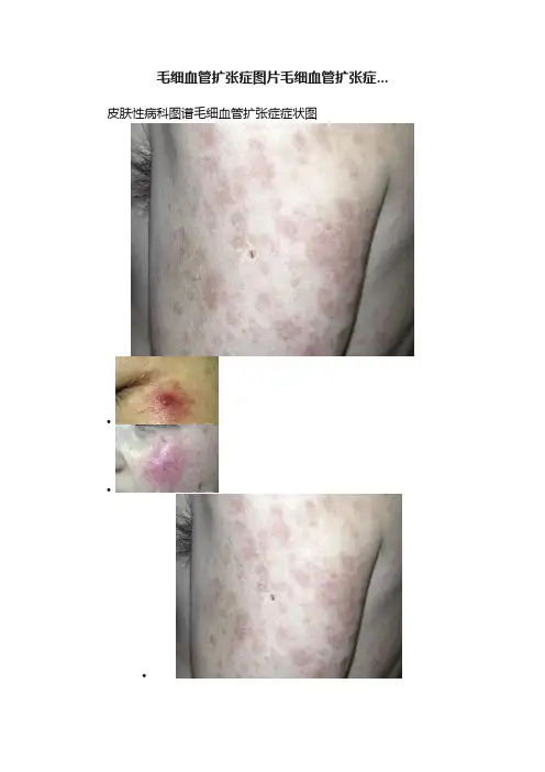 毛细血管扩张症图片毛细血管扩张症...