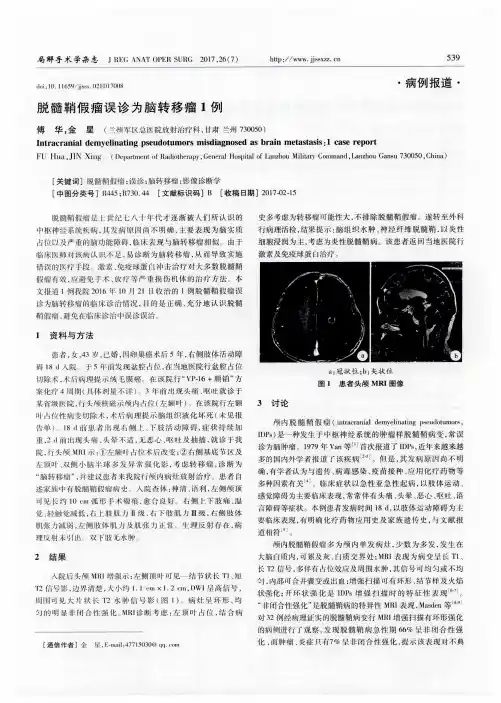 脱髓鞘假瘤误诊为脑转移瘤1例