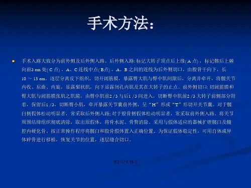 髋关节假体翻修