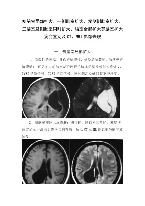 侧脑室局部扩大、一侧脑室扩大、双侧侧脑室扩大、三脑室及侧脑室同时扩大等脑室扩大病变鉴别及影像表现