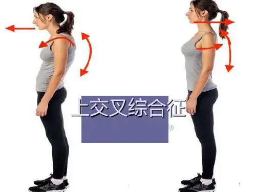 上交叉综合症ppt课件