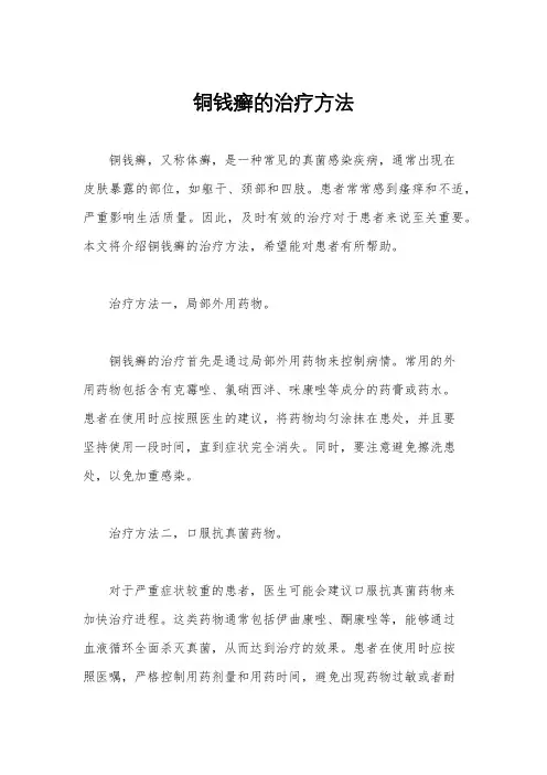铜钱癣的治疗方法
