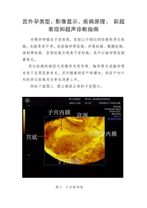 宫外孕类型、影像显示、疾病原理、 彩超表现和超声诊断指南