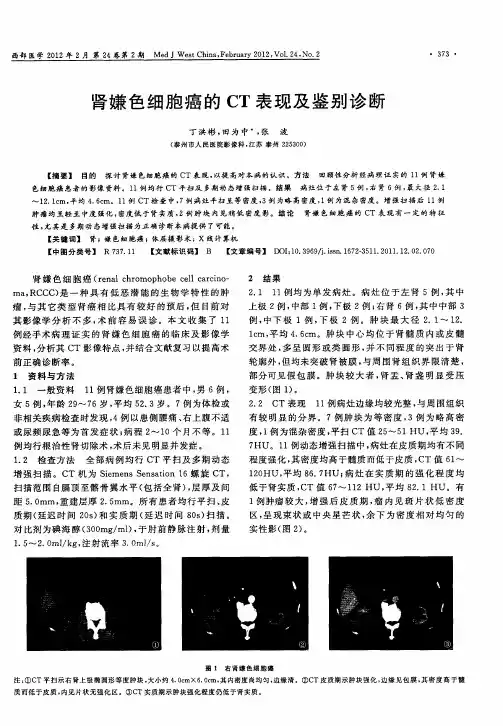 肾嫌色细胞癌的CT表现及鉴别诊断