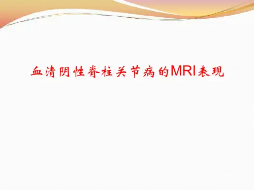 血清阴性脊柱关节病的MRI表现
