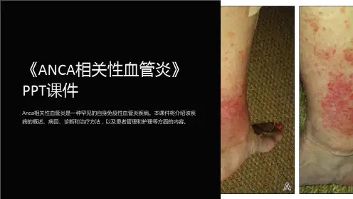 《ANCA相关性血管炎》课件