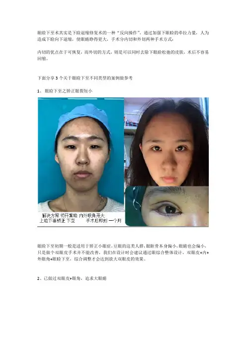 眼睑下至手术方式以及案例分享 (二)