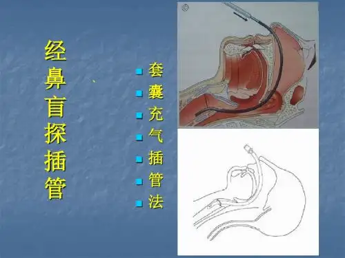经鼻盲探插管