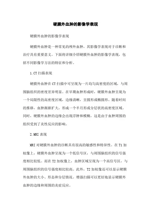 硬膜外血肿的影像学表现