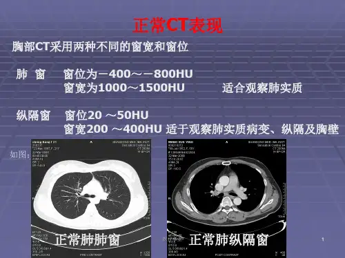正常胸肺部CT影像学深层分析