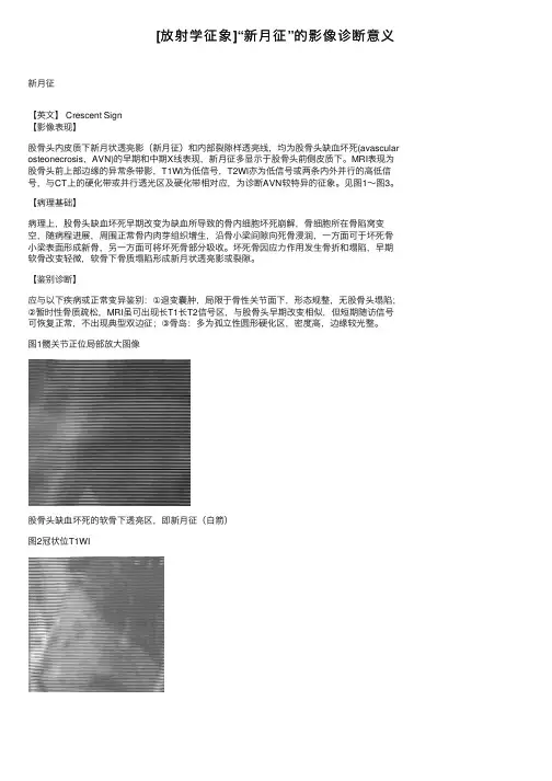 [放射学征象]“新月征”的影像诊断意义