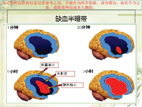急性脑梗死静脉溶栓培训课件