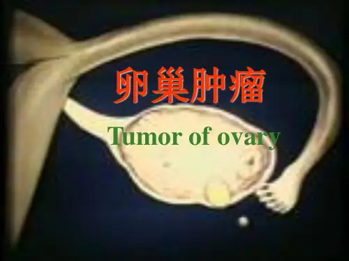 卵巢肿瘤 (rq)