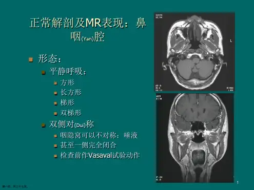 鼻咽癌MR治疗及诊断基础培训ppt
