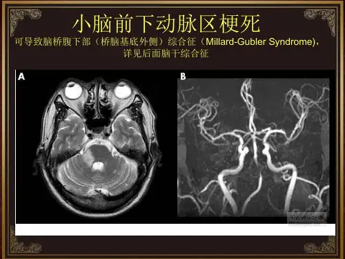脑血管解剖及脑梗塞定位诊断-迷路动脉(1)