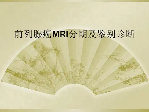 前列腺癌MRI分期及鉴别诊断