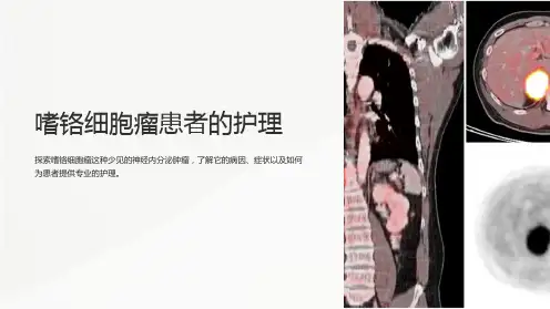 嗜铬细胞瘤患者的护理